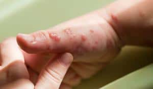 blister shingles