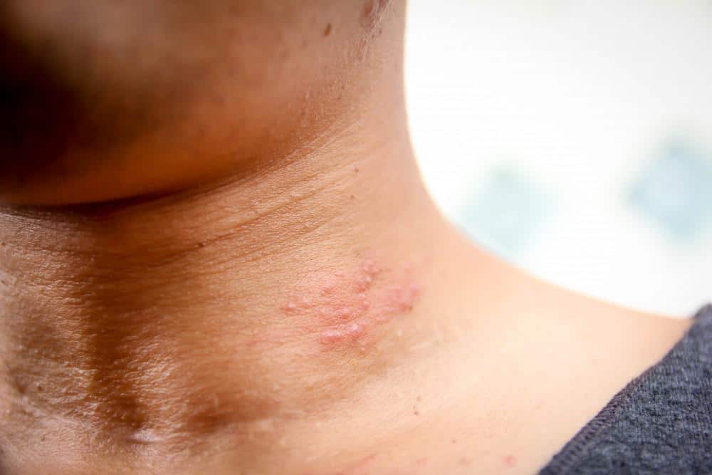 Can You Squeeze Blisters From Shingles?