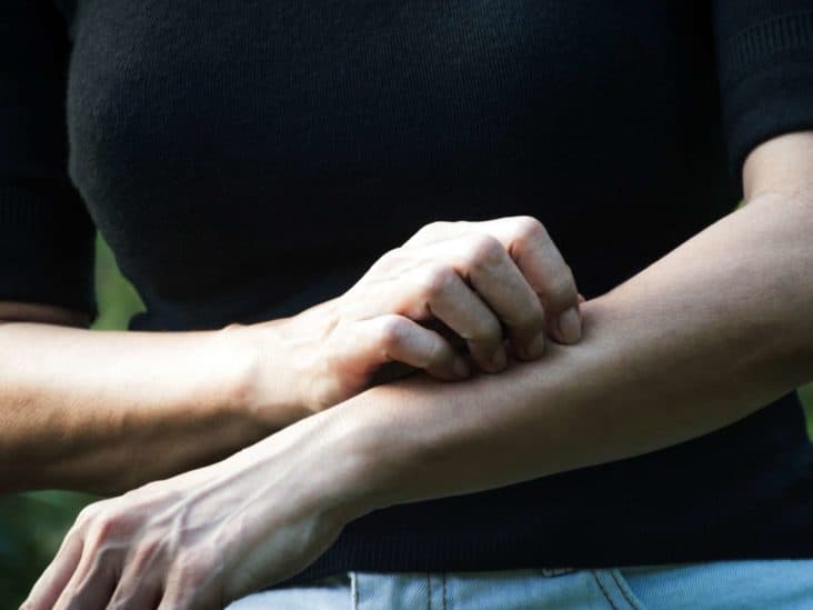 How Likely Is One To Get Shingles?