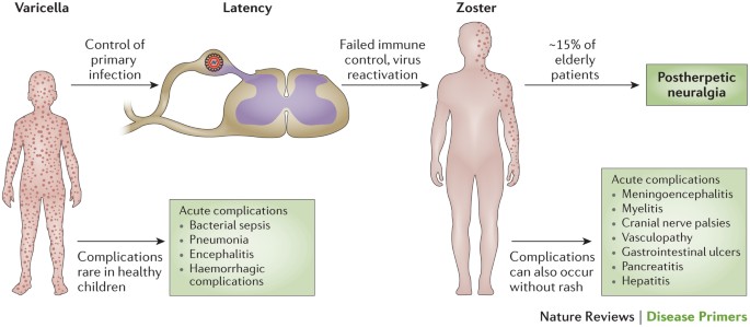 vzv outbreak